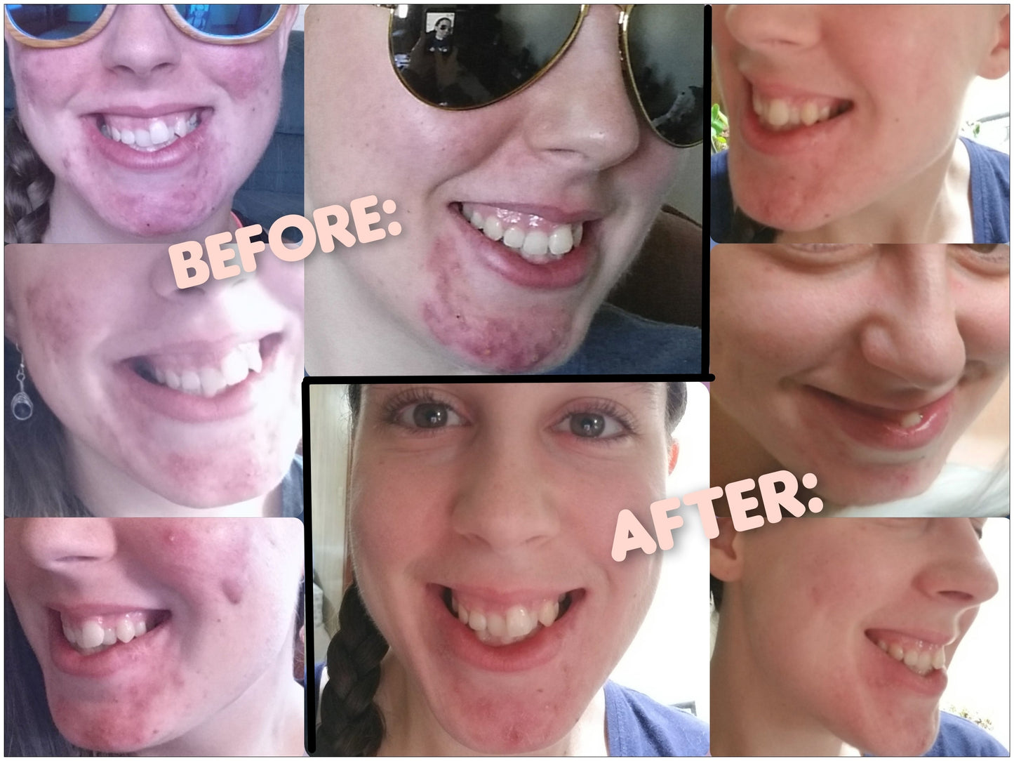 Before and after images showing clear skin transformation using By Robin Creations Clear Skin Acne Clarifying Facial Toner Spray.